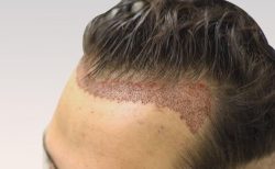 Best Hair Transplant in Hyderabad