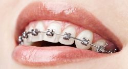 HOW DOES OVERBITE CORRECTION WORK WITH BRACES?