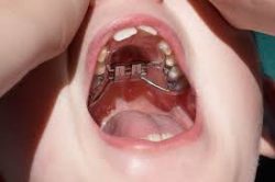 Palate Expander Appliance