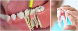 Root Canal Treatment Procedure