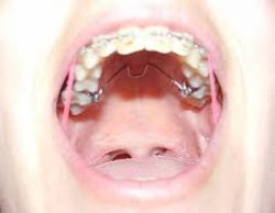 Trans Palatal Arch Tpa Appliance Braces