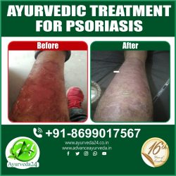 Very effective Ayurveda treatment for Psoriasis