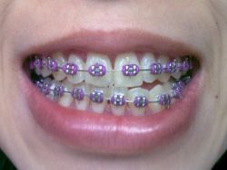 HOW TO CHOOSE GOOD BRACE COLORS THAT BEST SUITS YOU?