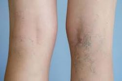 Varicose Vein Removal Near Me