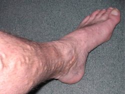 Varicose Veins Treatment Near Me