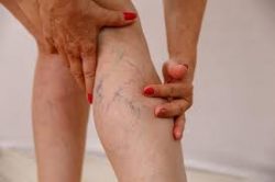 Varicose Vein Clinic Near Me