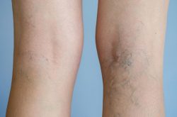 Vein Treatment Clinic Near Me