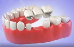 What Are Dental Bridges?