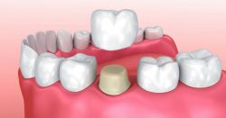 What Are Dental Crowns?