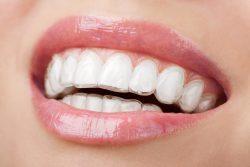 What Is Invisalign?