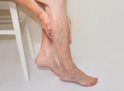 Vein Treatment Specialist Near Me