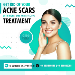 Acne Scar Treatment in Bangalore