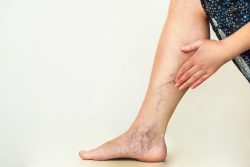 Varicose Vein Center Near Me