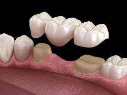 Dental Crown Treatment and Procedure | URBN Dental Houston Tx