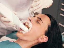 Dental Deep Cleaning Houston