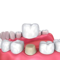 What is a Dental Crown | Top Dentist Houston | Types of Dental Crowns