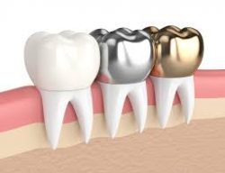 Dental Crowns Houston Open Saturday