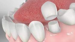 Dental Crown vs Filling | Tooth Restoration Procedures