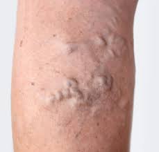 Spider vein and varicose vein treatment