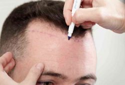 Cost of Hair Transplant in Jaipur – Dr. Akangsha Sharma