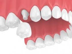 Affordable Dental Crowns in Houston
