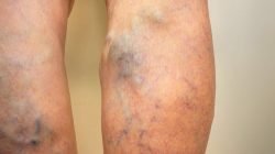 Find a top spider vein doctor in New Jersey