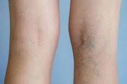 What is the Best Spider Vein Clinic in San Diego?