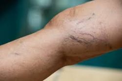The Best Spider Vein Clinic in Clifton, NJ