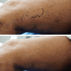 Spider Vein Treatment Near Me