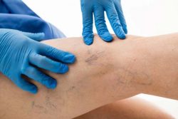 Spider Vein Treatment Near Me