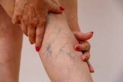 Spider Vein Treatment Near Me