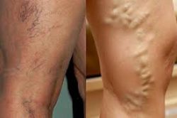 North Shore Spider Vein Treatment Near Me