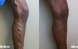 Varicose Vein Treatment Near Me