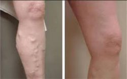 Spider Vein Treatment Near Me