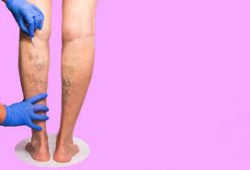 Spider Vein Treatment Professional in San Jose