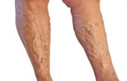 Cheap Varicose Vein Treatment San Jose