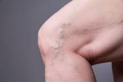 Best Varicose Vein Treatment near me San Jose