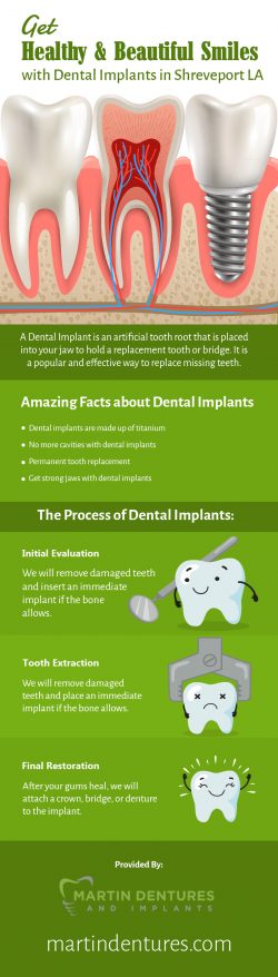 Martin Dentures and Implants – Replace your Missing Teeth with Dental Implants in Shrevepo ...