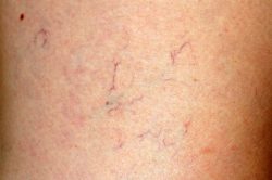 Spider Vein Treatment Near Me