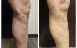 Spider Vein Treatment Near Me