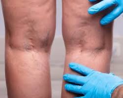 Woodland Park Varicose Vein Treatment Near Me