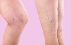 Woodland Park Varicose Vein Treatment Near Me