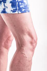 Vein Treatment Center Near Me