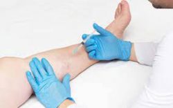 Spider Vein Treatment Near Me