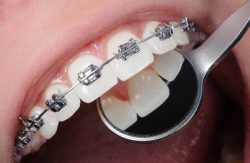 Pediatric Dentist and Orthodontist Near Me in Miami | Ivanov Orthodontic