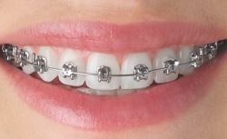 Best Local Orthodontist Near Me
