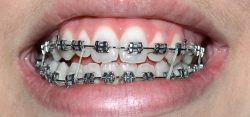 How To Find The Best Orthodontics In Aventura, Fl?