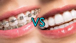 How To Find Orthodontic Treatment In Aventura, Fl?