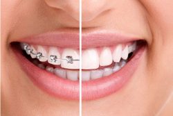 How To Find Orthodontic Treatment In Aventura, Fl?