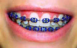 What Are The Best Braces Colors?
